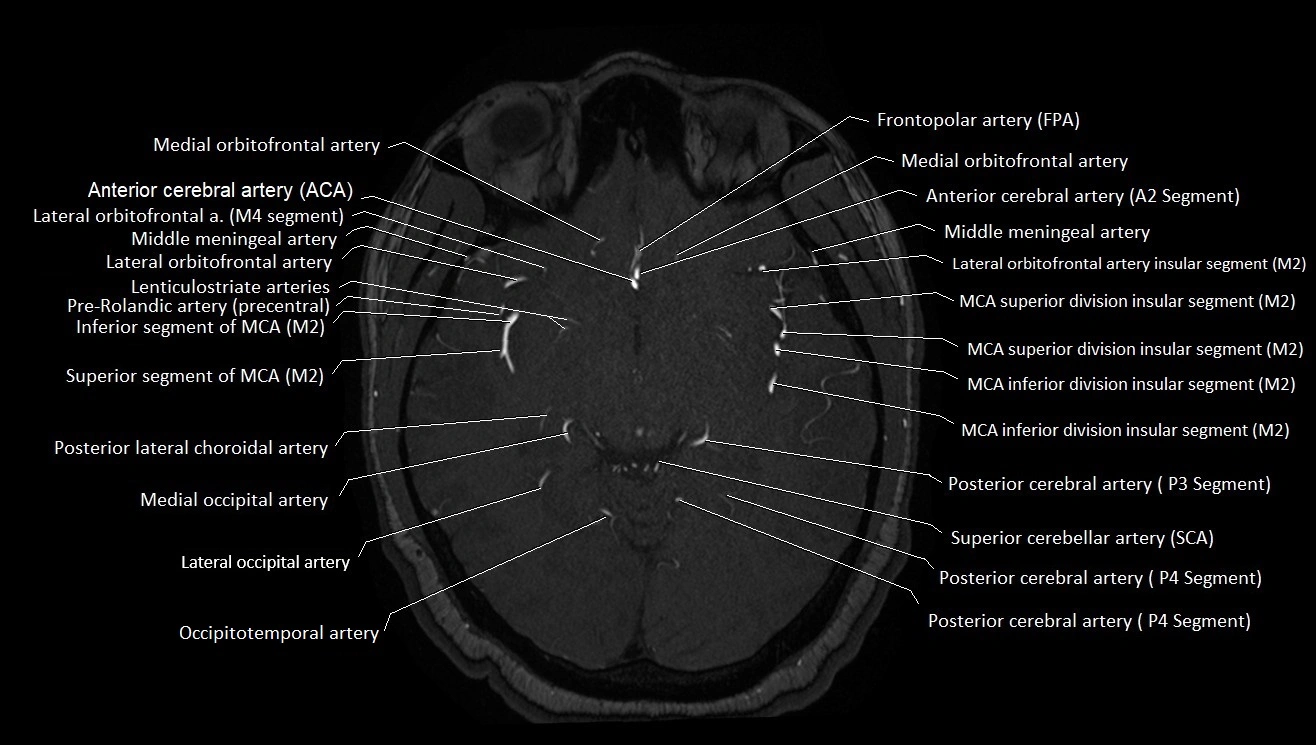 MRA brain (cerebral arteries) anatomy axial 3T image 21.webp